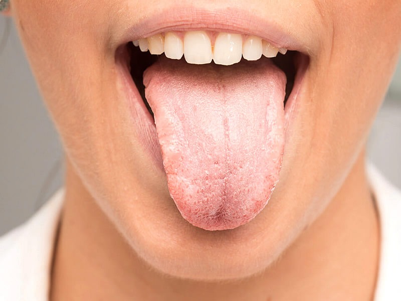 Чи відчуваєте печіння в роті після їжі? У цього є 2 причини — одна гірша за іншу